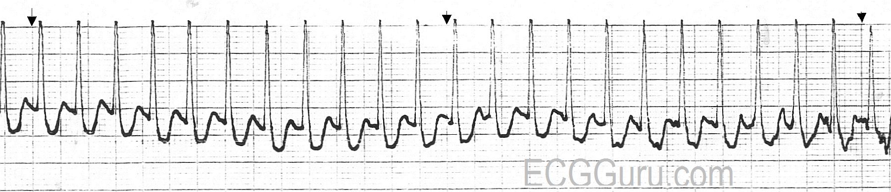 ecg-basics-paroxysmal-supraventricular-tachycardia-converted-with